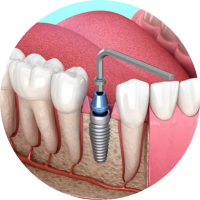 CHẾ ĐỘ BẢO HÀNH CỦA LOẠI TRỤ