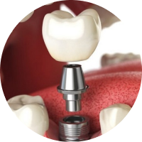 LỰA CHỌN TRỤ IMPLANT CÓ KÍCH THƯỚC NHỎ