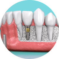LỰA CHỌN TRỤ IMPLANT CÓ KÍCH THƯỚC NHỎ