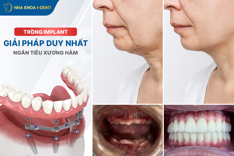 răng implant tồn tại bao lâu