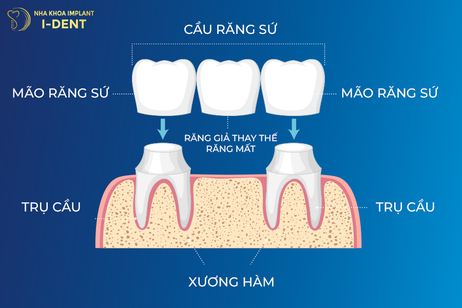 hình ảnh cầu răng sứ