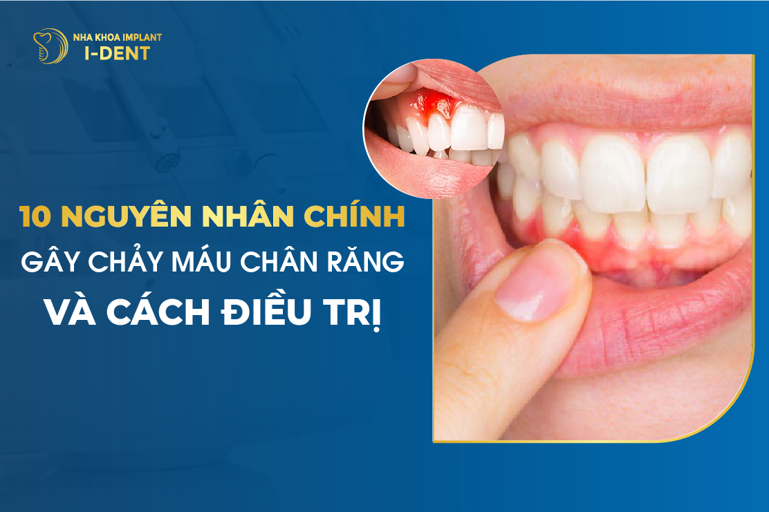 10 Nguyên Nhân Chính Gây Chảy Máu Chân Răng Và Cách Điều Trị 