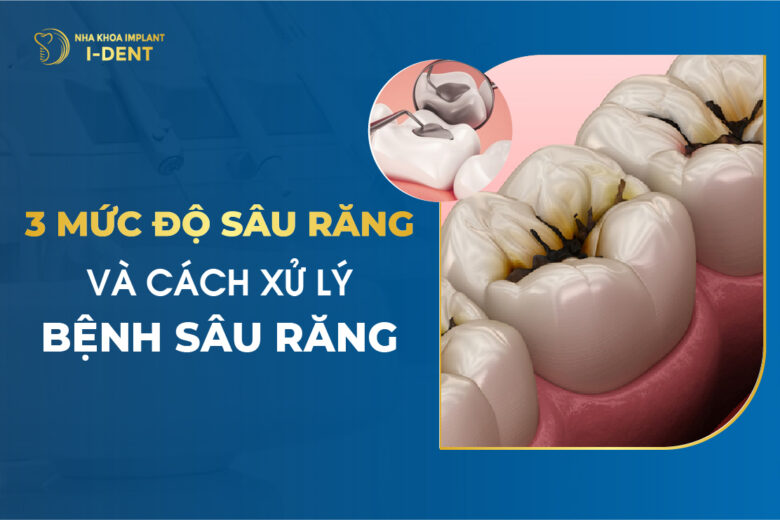 3 Mức Độ Sâu Răng Từ Nhẹ Đến Nặng Và Cách Xử Lý
