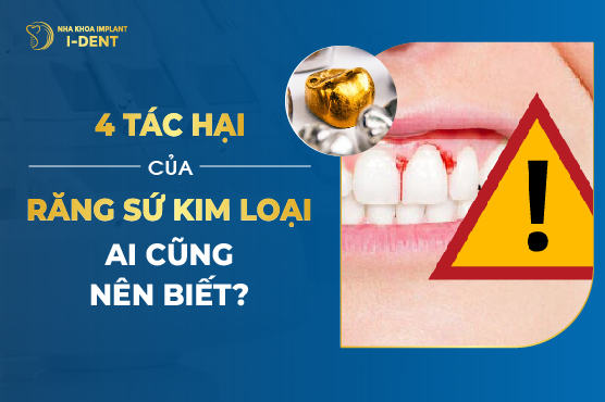 Các Tác Hại Của Răng Sứ Kim Loại Cần Lưu Ý