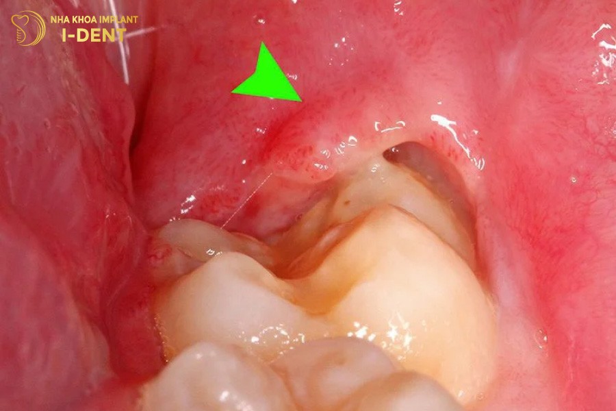 Bien-chung-nhiem-trung-do-moc-rang-khon