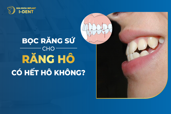 Bọc Răng Sứ Cho Răng Hô Có Hết Hô Không?