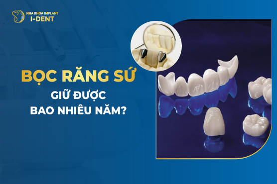 Bọc răng sứ được bao lâu thì hỏng? Tuổi thọ bao nhiêu năm?