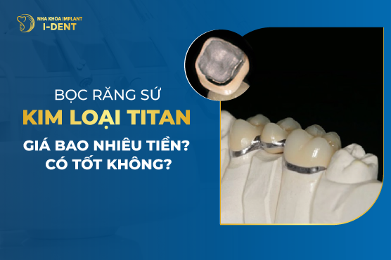 Trồng Răng Sứ Titan Giá Bao Nhiêu Tiền? Bảng Giá Mới Nhất 2026
