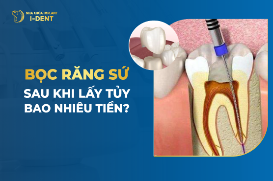 Lấy Tủy Bọc Răng Sứ Giá Bao Nhiêu? Bảng Giá Chi Tiết