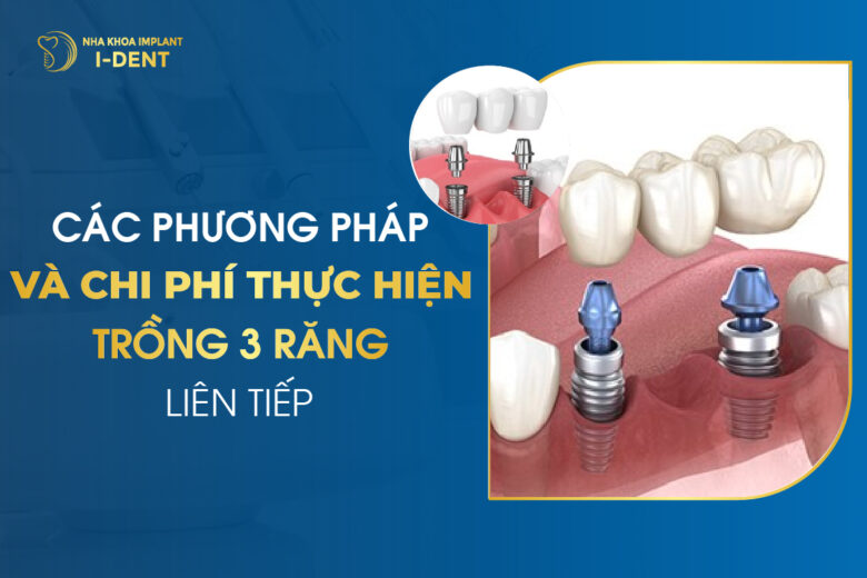 Các Phương Pháp Và Chi Phí Thực Hiện Trồng 3 Răng Liên Tiếp