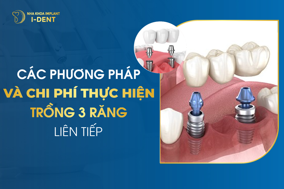 Các Phương Pháp Và Chi Phí Thực Hiện Trồng 3 Răng Liên Tiếp