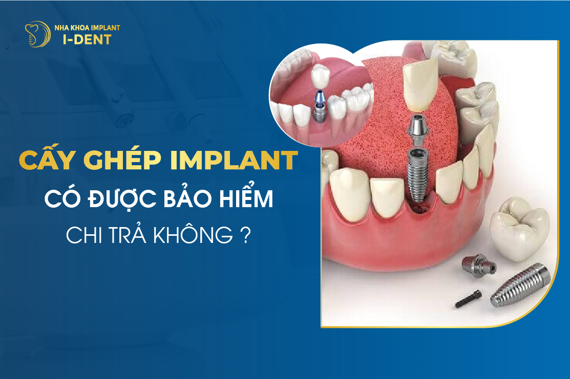 Cấy Ghép Implant Có Được Bảo Hiểm Chi Trả Hay Không?