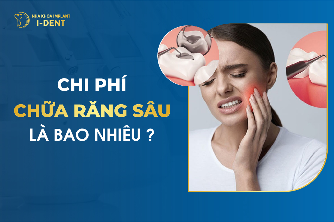 Chi Phí Chữa Răng Sâu Là Bao Nhiêu?