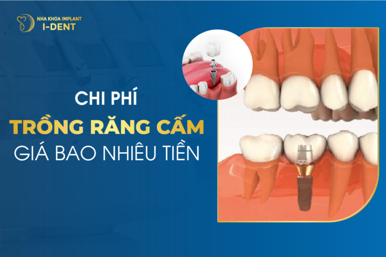 Chi Phí Trồng Răng Cấm Giá Bao Nhiêu Tiền? Bảng Giá Mới Nhất 2026