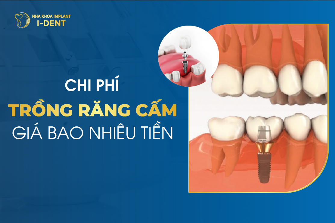 Chi Phí Trồng Răng Cấm Giá Bao Nhiêu Tiền? Bảng Giá Mới Nhất 2026