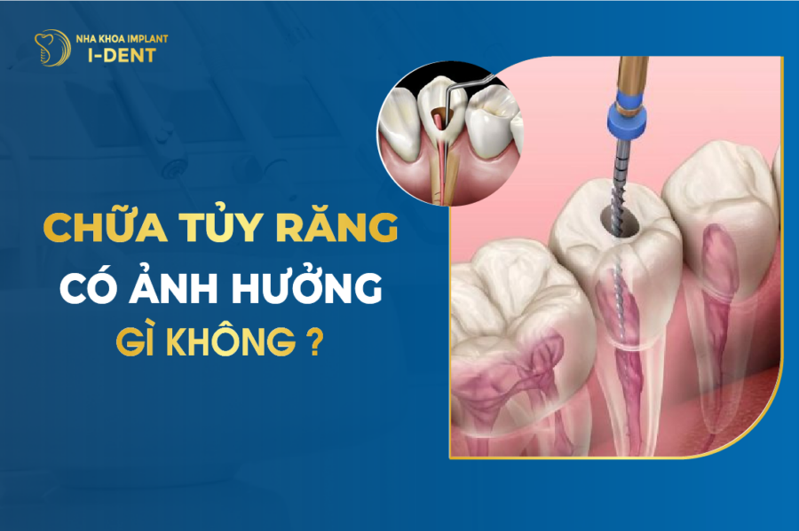 răng lấy tủy bọc sứ được bao lâu