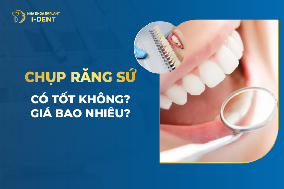 Chụp Răng Sứ Có Tốt Không? Giá Bao Nhiêu?