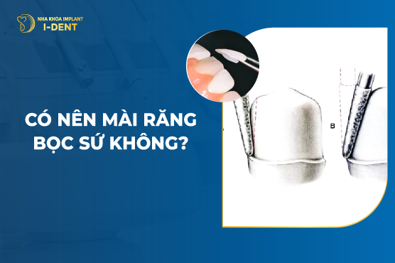 Có Nên Mài Răng Bọc Sứ Không? Nha Khoa I-DENT