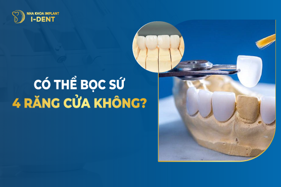 Có Thể Bọc Sứ 4 Răng Cửa Không?