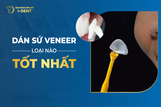 Dán Sứ Veneer Loại Nào Tốt Nhất?
