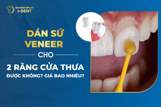 Dán sứ veneer cho 2 răng cửa thưa được không? Giá bao nhiêu?