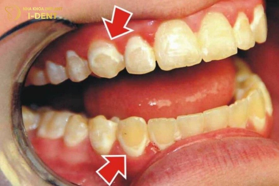 Dom-trang-xuat-hien-la-dau-hieu-cua-sau-men-rang