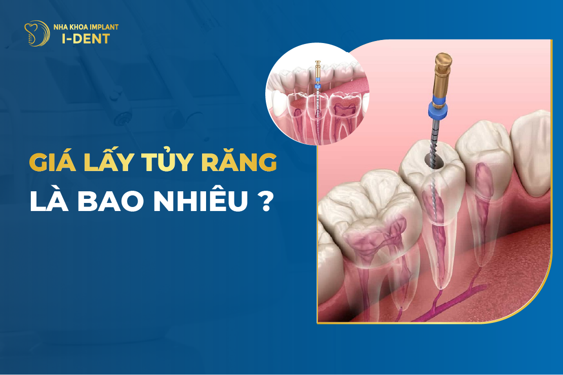 Giá Lấy Tủy Răng Là Bao Nhiêu?