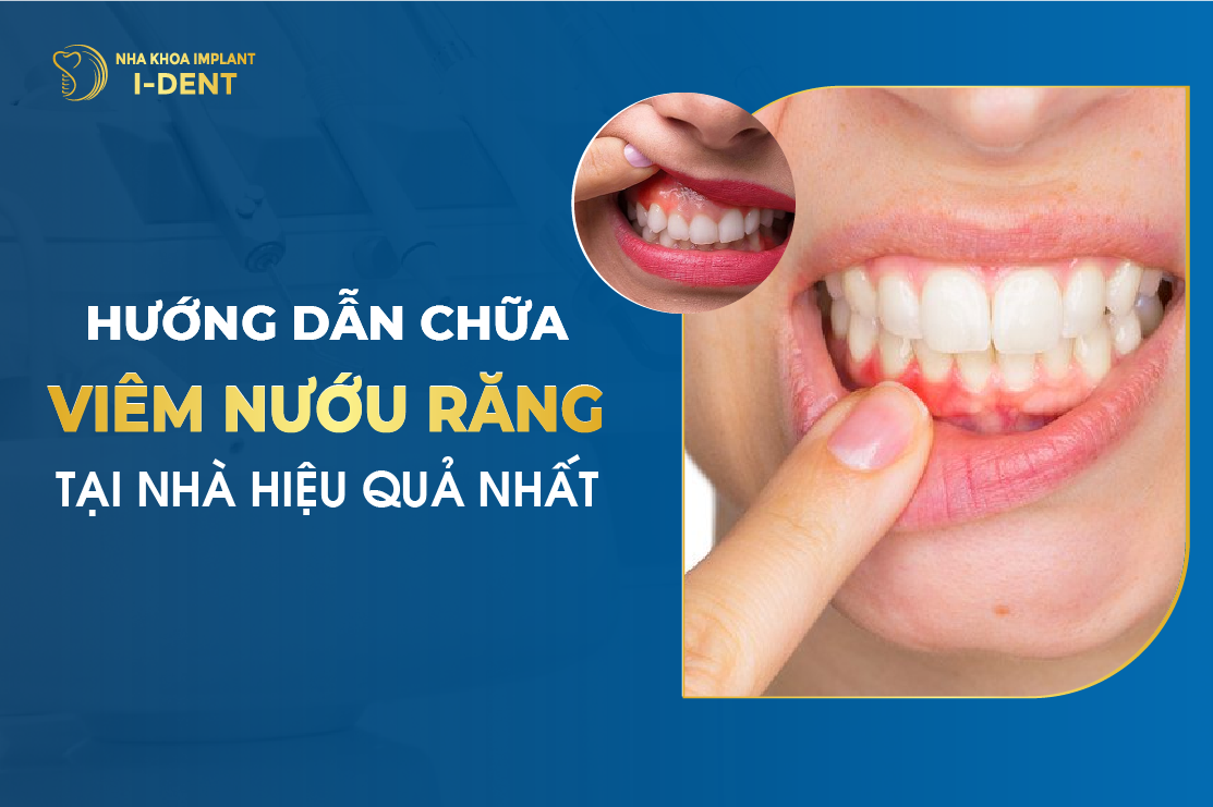 Viêm nướu làm sao hết? Dấu hiệu và cách trị viêm nướu tại nhà