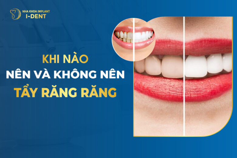 Tẩy trắng răng: Có nên không? Chi phí và các phương pháp
