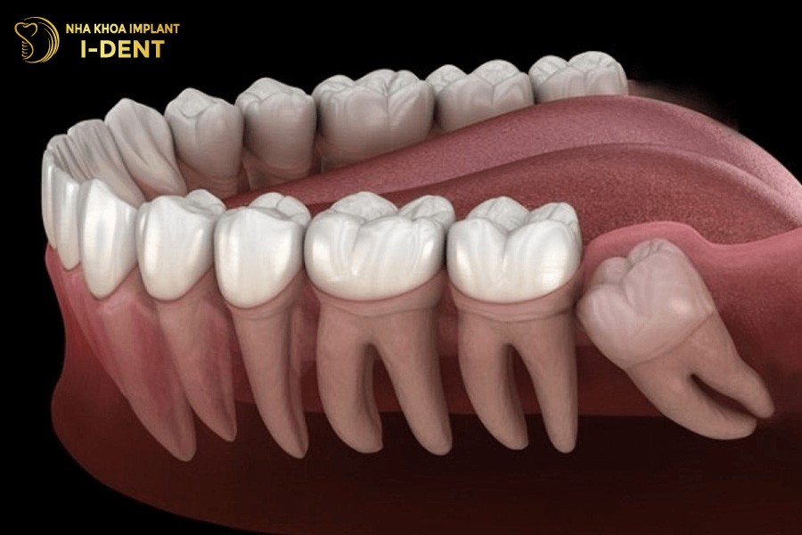 Khong-phai-ai-cung-moc-rang-khon