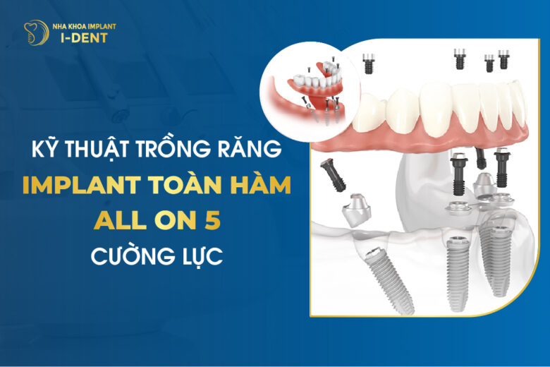 Kỹ Thuật Trồng Răng Implant Toàn Hàm All-on-5 Cường Lực