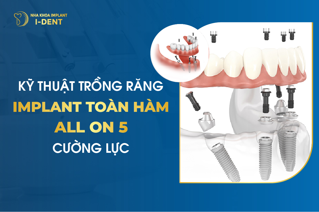 Kỹ Thuật Trồng Răng Implant Toàn Hàm All-on-5 Cường Lực