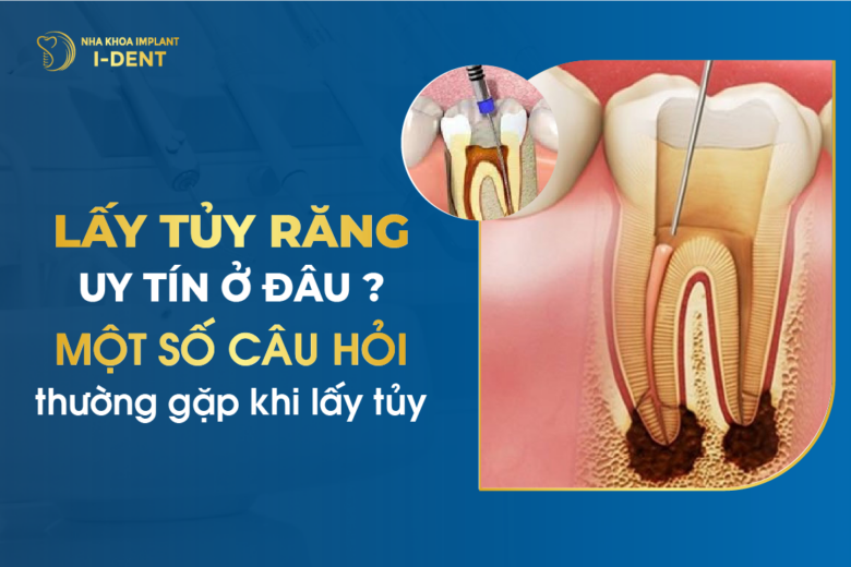 Địa Chỉ Chữa Tủy Răng Tại TPHCM Uy Tín Và Giá Rẻ Nhất