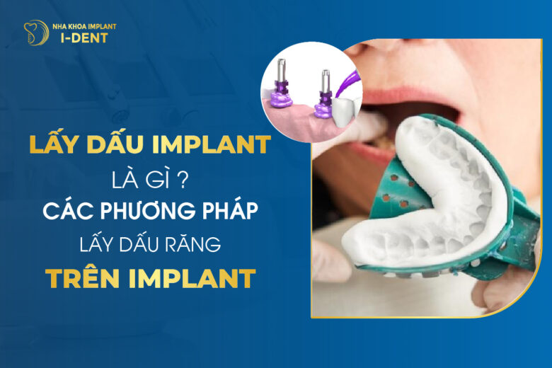 Lấy dấu phục hình trên implant là gì? Quy trình và phương pháp