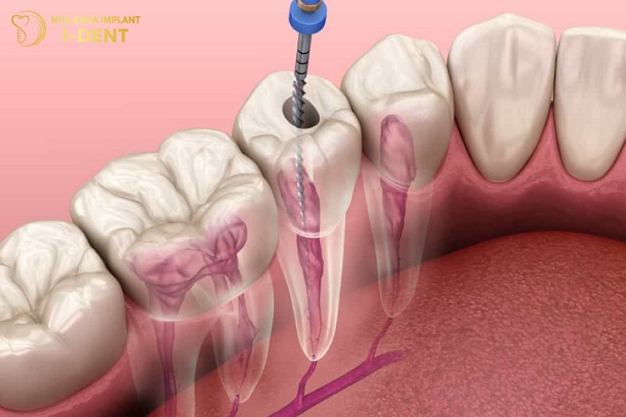 Lay-tuy-rang-co-the-anh-huong-den-thai-nhi