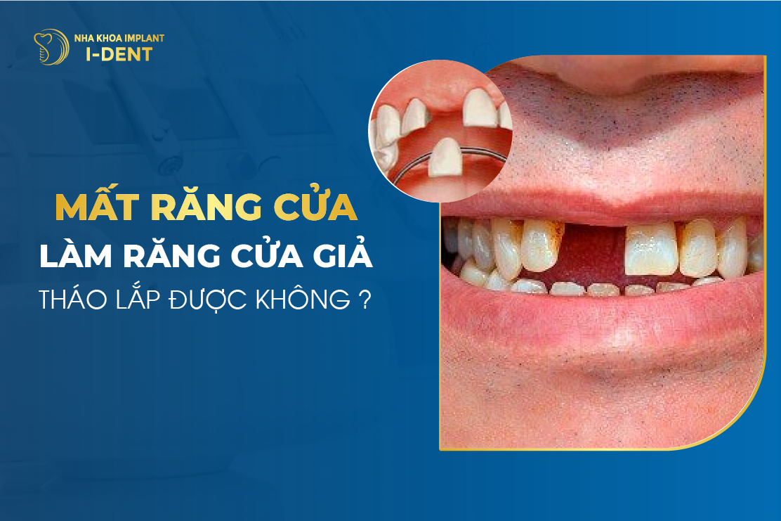 Mất răng cửa nên làm gì? Có sao không? Giải pháp khắc phục
