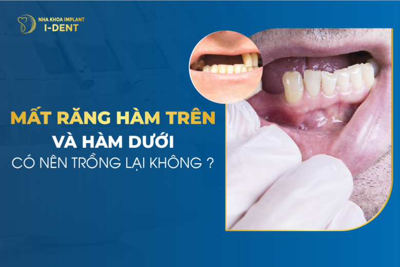 Chi phí trồng răng hàm bao nhiêu? Phương pháp trồng nào tốt?