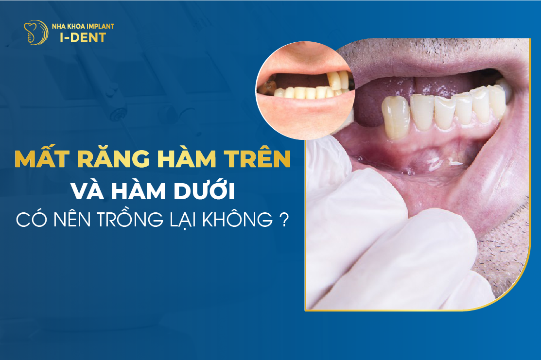 Chi phí trồng răng hàm bao nhiêu? Phương pháp trồng nào tốt?