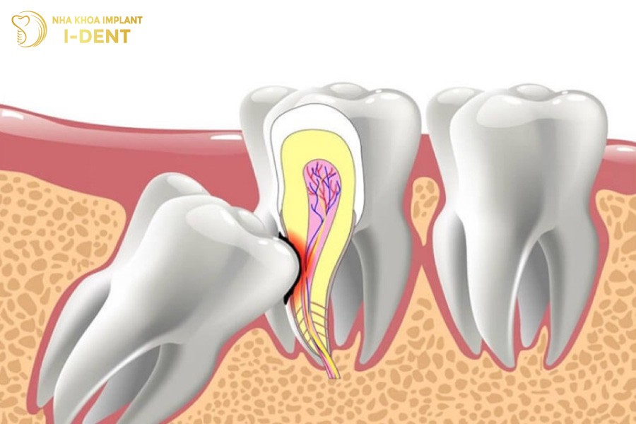 Moc-rang-khon-rang-so-8-de-dan-den-sau-rang-so-7