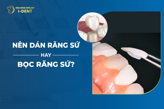 Nên Dán Sứ Hay Bọc Sứ Tốt Hơn? So Sánh Chi Tiết