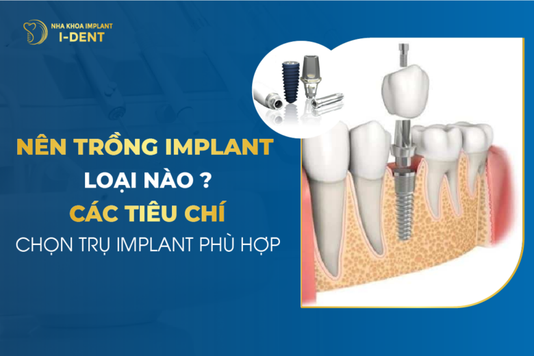 Top 6 Trụ Implant Phổ Biến Nhất Hiện Nay