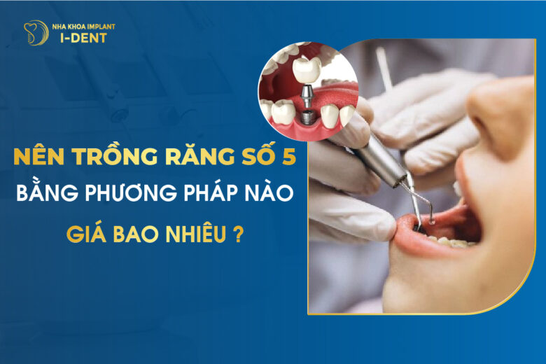 Nên trồng răng số 5 bằng phương pháp nào và giá bao nhiêu?
