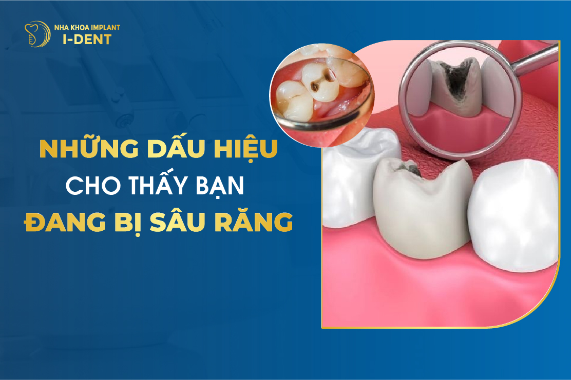 Những Dấu Hiệu Cho Thấy Bạn Đang Bị Sâu Răng