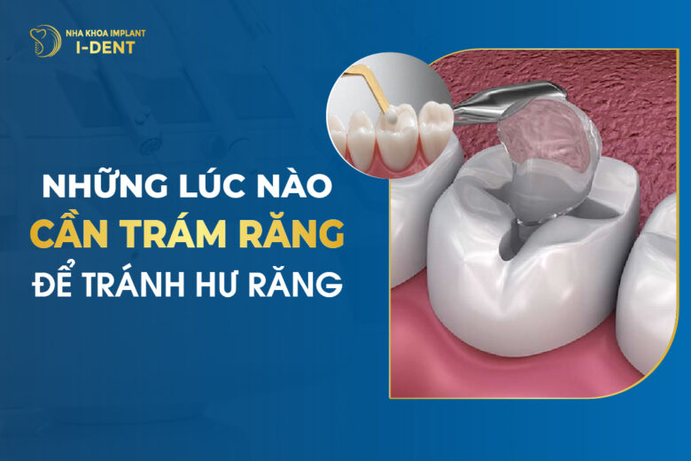 Những Lúc Nào Cần Phải Trám Răng Để Tránh Hư Răng?