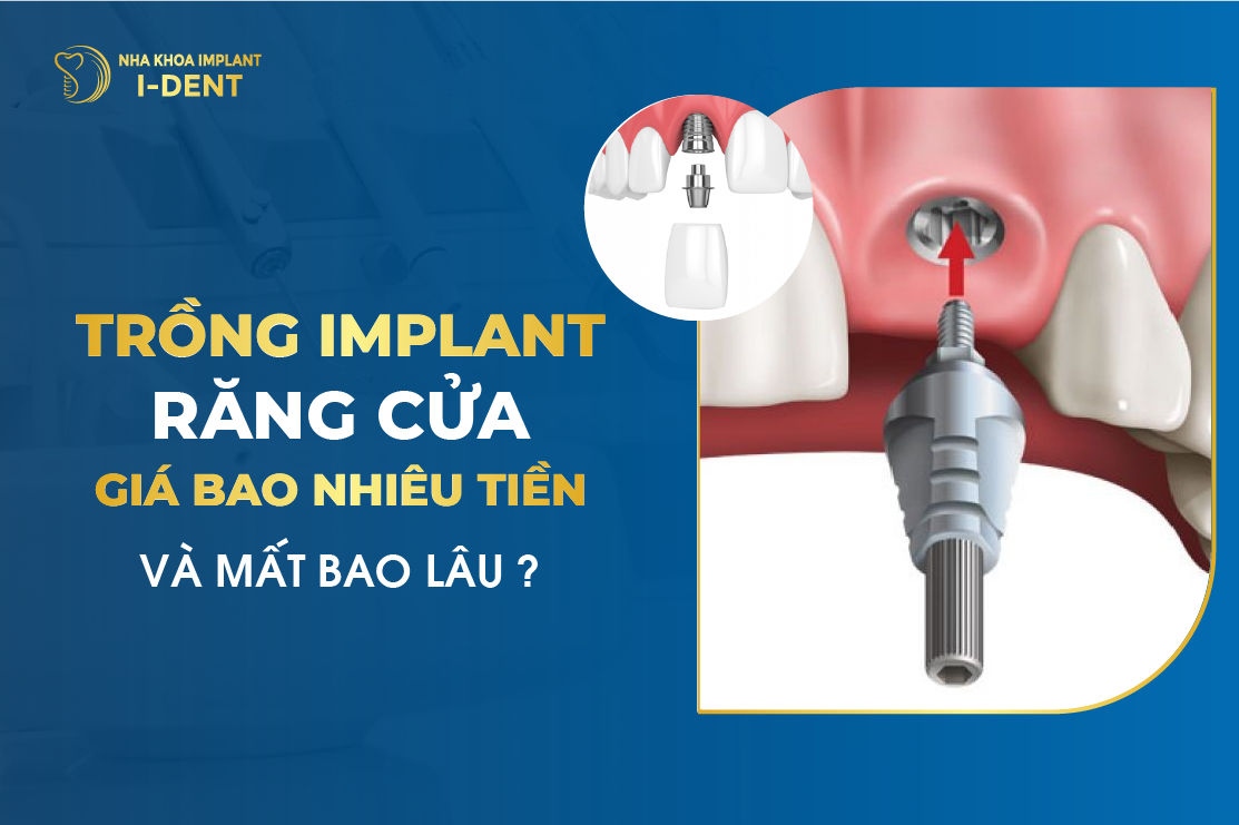 Trồng Implant Răng Cửa Giá Bao Nhiêu Tiền Và Mất Bao Lâu?