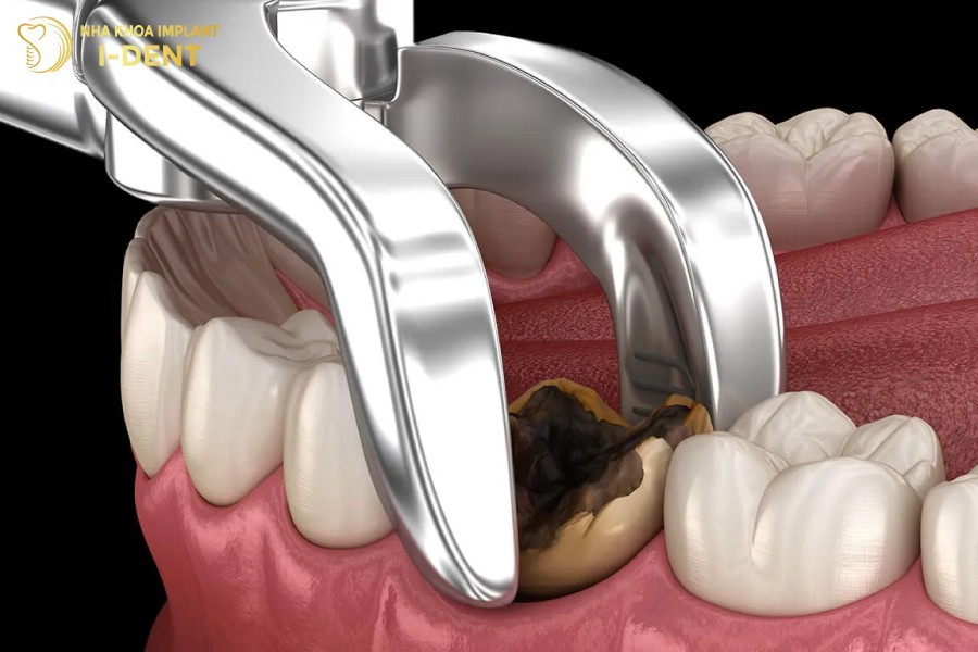 Nhổ răng là chỉ định bắt buộc nếu răng đã bị tổn thương nghiêm trọng