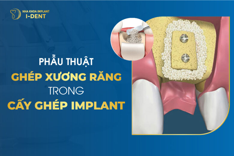 Ghép xương là gì? Bao lâu thì lành? Quy trình thực hiện