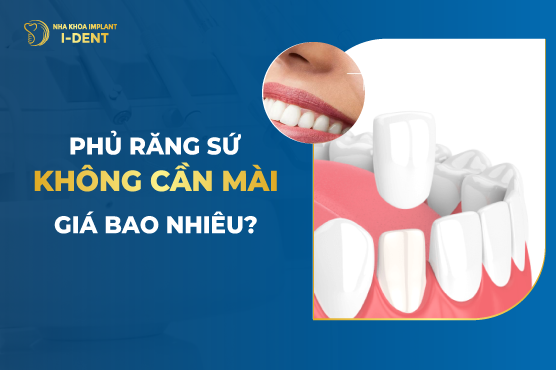 Phủ Răng Sứ Không Cần Mài Giá Bao Nhiêu?