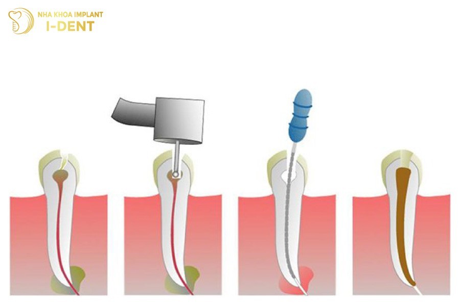 Quy-trinh-dat-thuoc-diet-tuy-rang