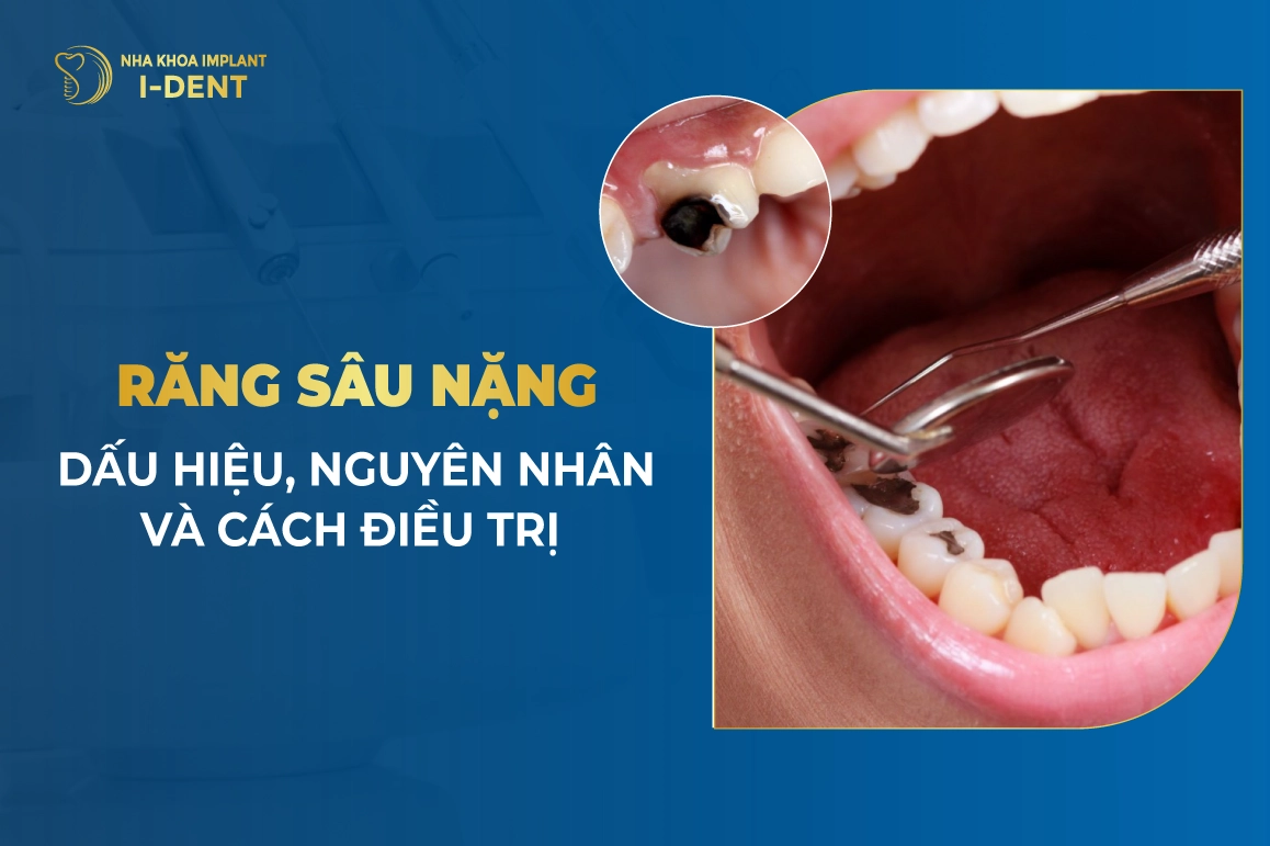Dấu Hiệu, Nguyên Nhân Và Cách Điều Trị Răng Sâu Nặng